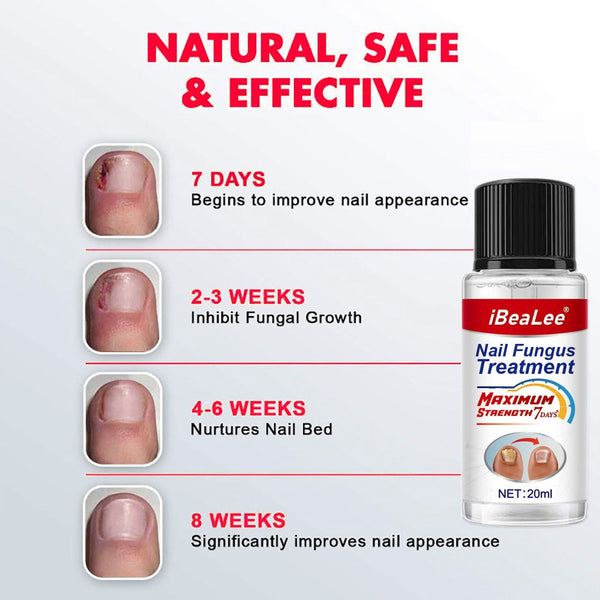 100% Original Nail Fungus Treatment 7DAYS Repair