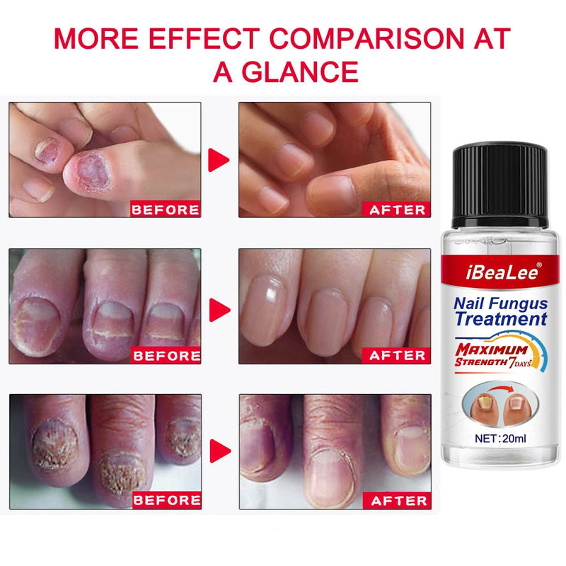 100% Original Nail Fungus Treatment 7DAYS Repair