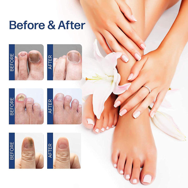 SUAI Nail Fungal Treatment Feet Care Essence Foot